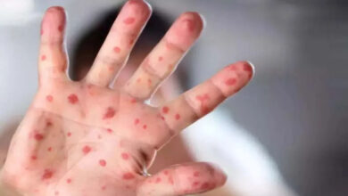 New cases of monkeypox-measles surfaced, Medical Association said this