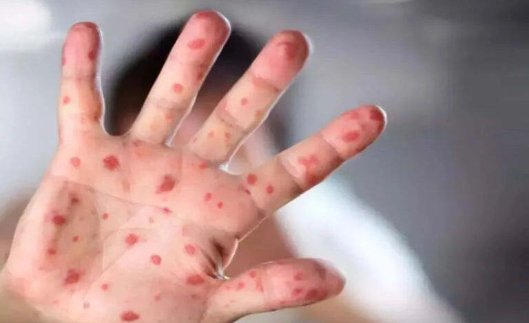 New cases of monkeypox-measles surfaced, Medical Association said this