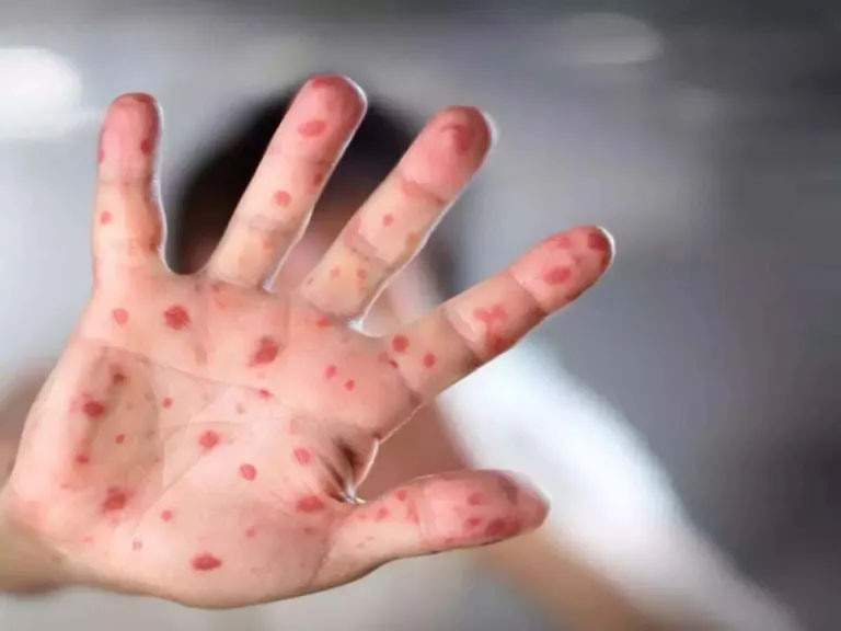 New cases of monkeypox-measles surfaced, Medical Association said this