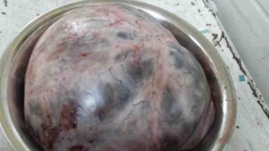 Doctors removed a 10 kg tumor from a woman's stomach, see picture