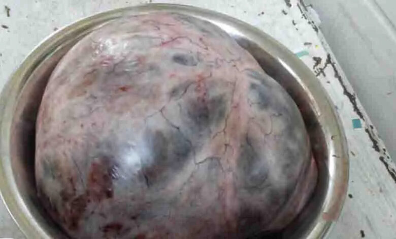 Doctors removed a 10 kg tumor from a woman's stomach, see picture