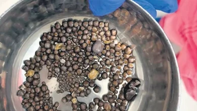 AINU doctors removed 418 stones from the kidney of a 60 year old man